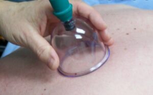 cupping therapy