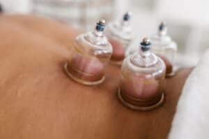 Cupping therapy