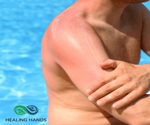 Man in pool with sunburn