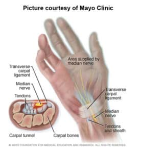 diagram of a hand with a focus on carpal tunnel